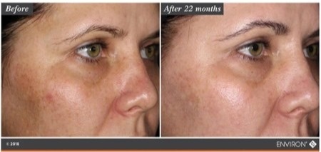 Environ Mela-Fade Serum System A+B Zestaw serum na przebarwienia 2 x 30 ml